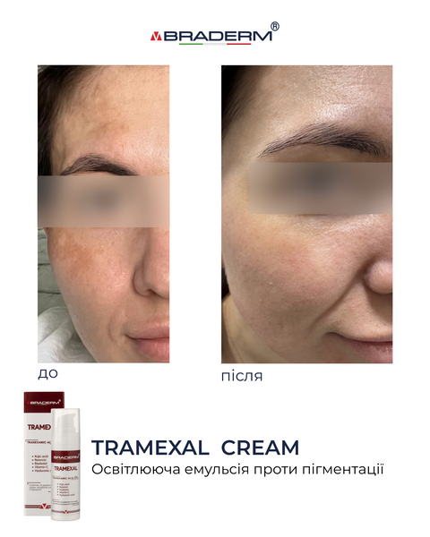Освітлюючий крем проти пігментації Braderm Tramexal Cream 30 ml 00-00000388 фото