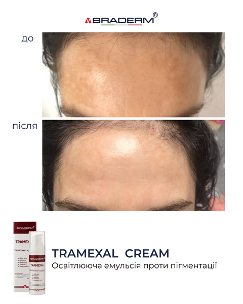 Освітлюючий крем проти пігментації Braderm Tramexal Cream 30 ml 00-00000388 фото