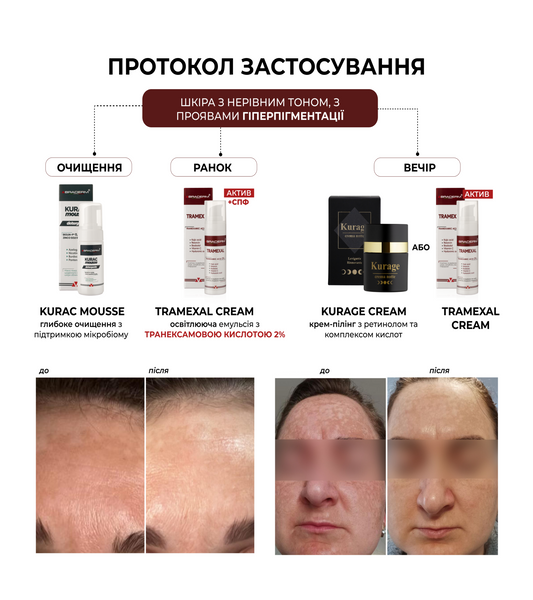 Освітлюючий крем проти пігментації Braderm Tramexal Cream 30 ml 00-00000388 фото